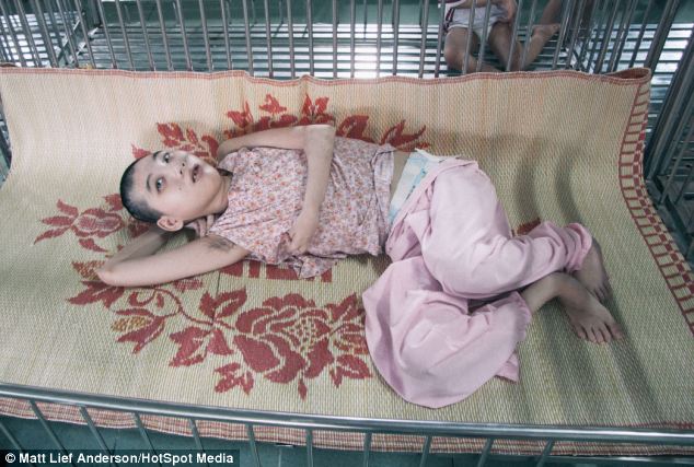 Tin thế giới - Hình ảnh trẻ em Việt Nam bị chất độc da cam lên báo Anh