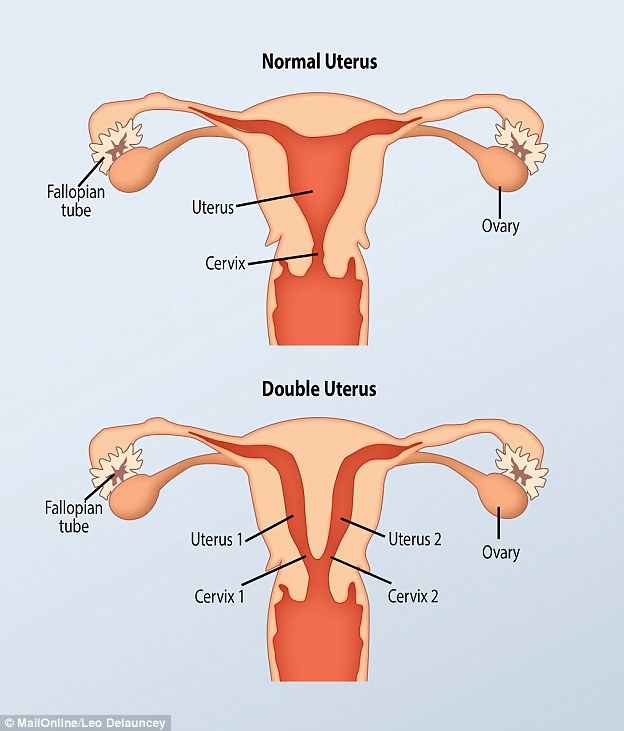 Sức khoẻ - Làm đẹp - Kỳ lạ người phụ nữ có 2 âm đạo nhưng chỉ có 1 quả thận (Hình 2).