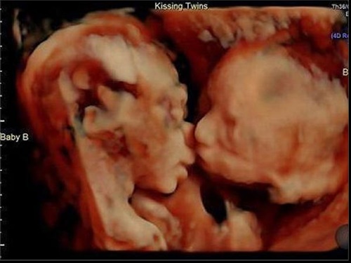 Cộng đồng mạng - Vợ chồng trẻ bất ngờ trông thấy hành động của cặp song thai trong bụng mẹ khi đi siêu âm (Hình 3).