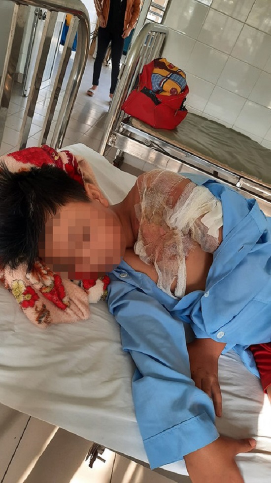 An ninh - Hình sự - Điều tra vụ cha tạt nước sôi khiến con trai 11 tuổi bị bỏng nặng ở Long An
