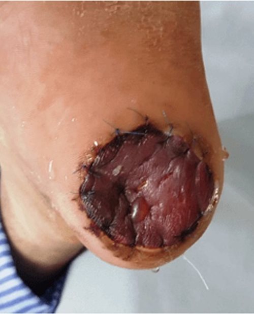 Sức khoẻ - Làm đẹp - Nốt ruồi biến thành ung thư, người đàn ông phải khoét gót chân (Hình 2).