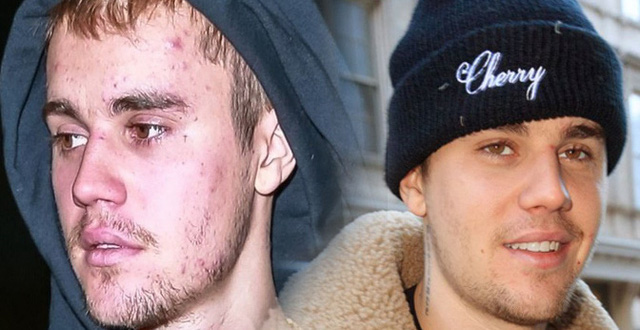 Sức khoẻ - Làm đẹp - Căn bệnh mà hoàng tử nhạc pop Justin Bieber mắc phải nguy hiểm cỡ nào?