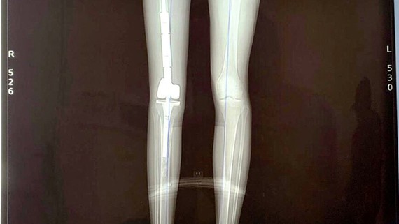 Sức khoẻ - Làm đẹp - Bệnh nhân đầu tiên đi lại được bằng xương đùi nhân tạo ở Việt Nam (Hình 2).