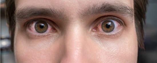 Ăn - Chơi - Giải mã bí ẩn: Mi mắt co giật liên tục là bệnh lý hay điềm gở? (Hình 3).