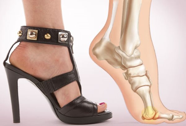 Sức khoẻ - Làm đẹp - Những kiểu giày dép gây hại cho chân chị em cần loại bỏ hoặc hạn chế sử dụng (Hình 3).