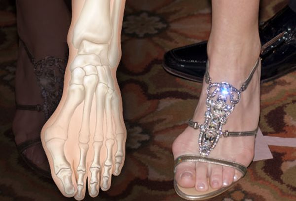 Sức khoẻ - Làm đẹp - Những kiểu giày dép gây hại cho chân chị em cần loại bỏ hoặc hạn chế sử dụng (Hình 6).