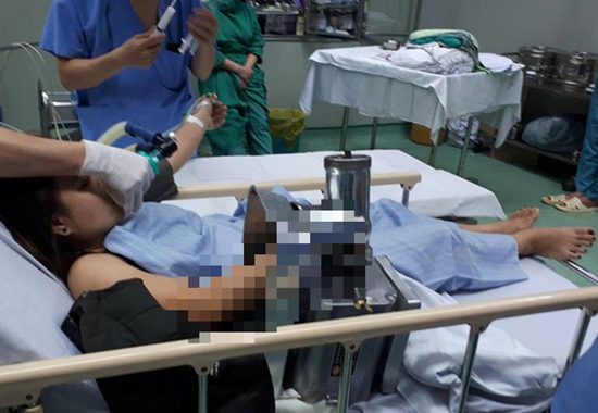 Tin trong nước - Người phụ nữ nhập viện cấp cứu với cánh tay bị cuốn vào máy xay thịt