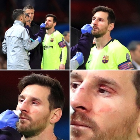 Bóng đá - Cận cảnh gương mặt bầm dập của Messi sau pha va chạm với hậu vệ MU (Hình 6).