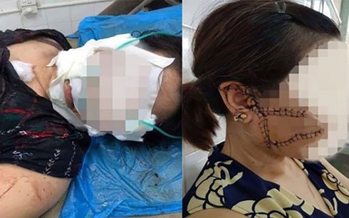 Tin tức - Tin tức mới nhất vụ chồng dùng dao rạch mặt, cắt gân chân 'vợ hờ' ở Bắc Giang