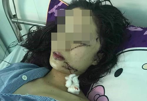 An ninh - Hình sự - Tin tức pháp luật mới nhất ngày 23/4/2019: Lộ nguyên nhân bất ngờ vụ cô gái 18 tuổi bị rạch mặt, khâu 60 mũi
