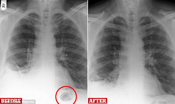 Sức khoẻ - Làm đẹp - Bị chẩn đoán có khối u trong phổi: Điều bất ngờ khi bác sĩ mở lồng ngực