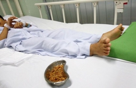 Đời sống - Bé trai 11 tuổi bị 70g hạt sơ-ri nảy mầm trong cơ thể