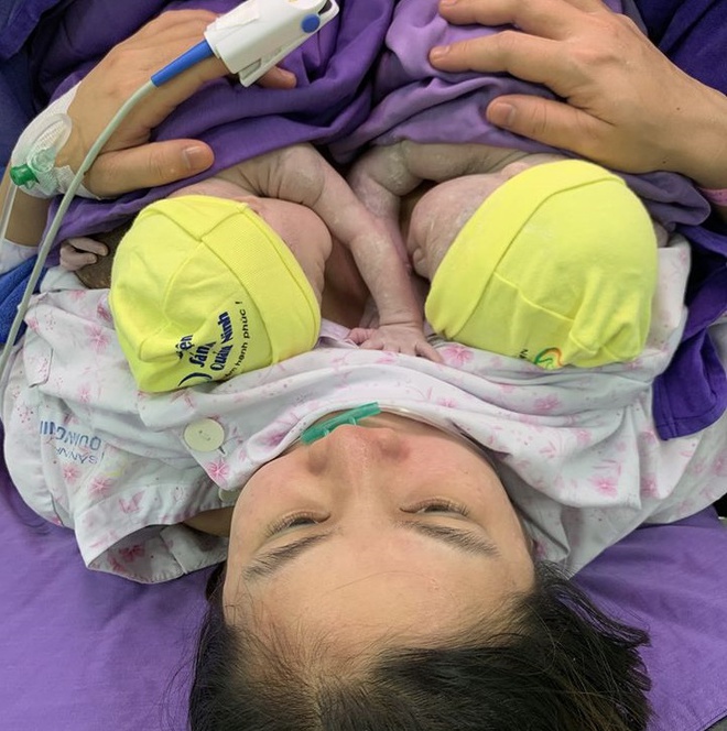 Đời sống - Quảng Ninh: Cặp song sinh chào đời trong bọc ối còn nguyên vẹn khiến ê-kíp phẫu thuật ngỡ ngàng