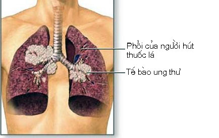 Y tế sức khỏe - Thuốc lá nguyên nhân chính gây ra ung thư phổi