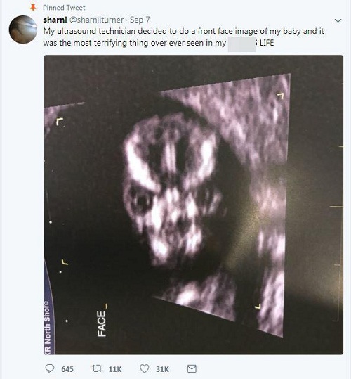 Cộng đồng mạng - Khoe bức ảnh siêu âm thai nhi kỳ lạ, người mẹ khiến nhiều người ngạc nhiên