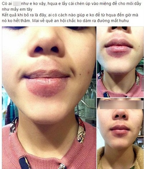 Sức khoẻ - Làm đẹp - Bơm môi bằng chén để sở hữu đôi môi tều, cô gái nhận cái kết đắng (Hình 6).