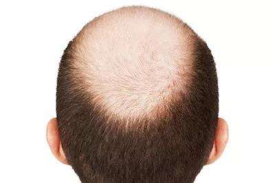 7 kiểu tóc giải quyết hói sớm ở đàn ông  bán tóc giả nam hói đầu
