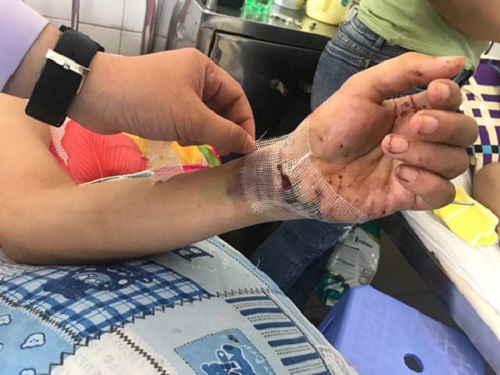 Tin tức - BV Đà Nẵng: Nối thành công bàn tay đứt lìa cho một bệnh nhân (Hình 2).