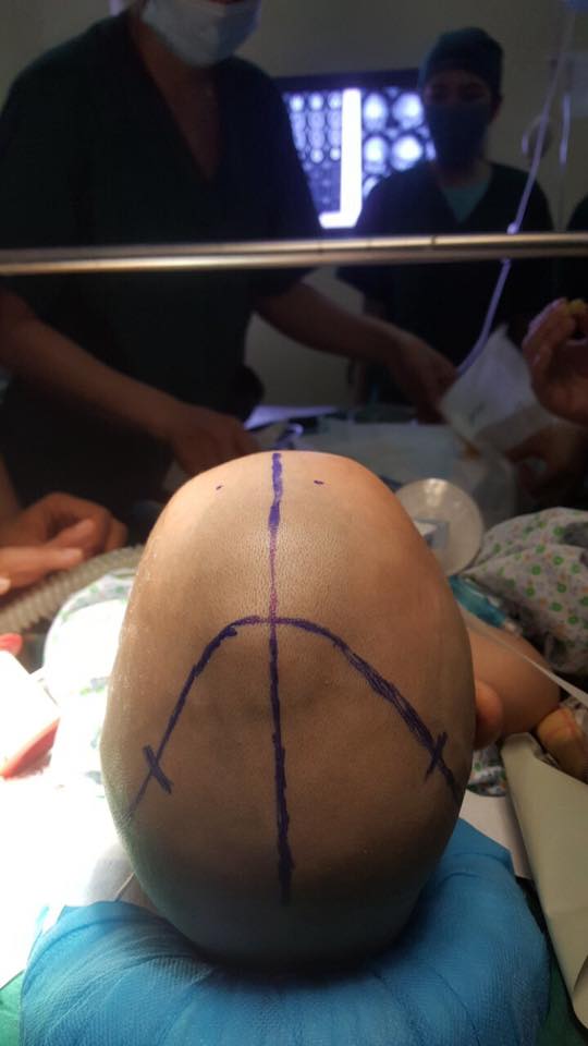 Sức khoẻ - Làm đẹp - Phẫu thuật thành công hộp sọ dị dạng bẩm sinh hiếm gặp cho bé 21 tháng tuổi (Hình 3).