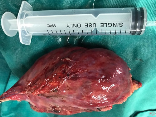 Tin tức - Quảng Ninh: Phẫu thuật nội soi lồng ngực cắt bỏ khối u 'khổng lồ' (Hình 2).