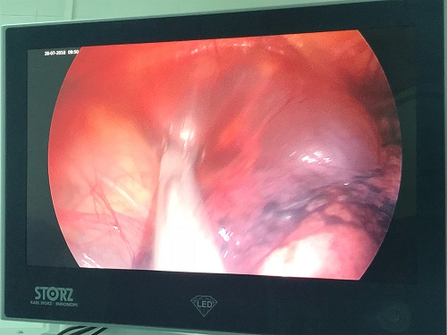 Tin tức - Quảng Ninh: Phẫu thuật nội soi lồng ngực cắt bỏ khối u 'khổng lồ'