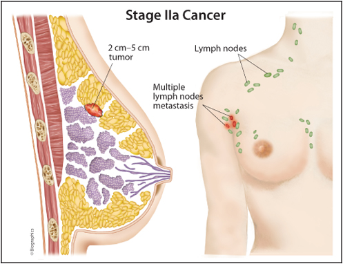 Sức khoẻ - Làm đẹp - Ung thư vú giai đoạn 2: Đặc điểm và dấu hiệu của bệnh
