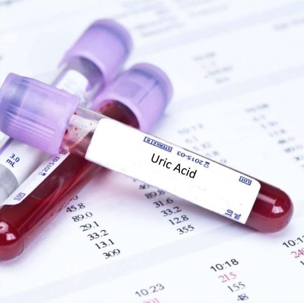 Cần biết - Acid uric cao bao nhiêu thì bị bệnh gout?