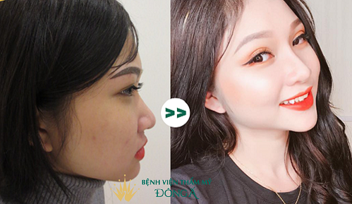 Sức khoẻ - Làm đẹp - Nâng mũi bằng sụn sườn, liệu đã là phương pháp chỉnh sửa tốt nhất? (Hình 2).