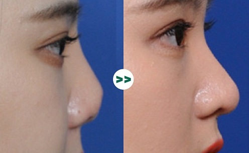 Sức khoẻ - Làm đẹp - 90% chị em lựa chọn nâng mũi cấu trúc khi phẫu thuật thẩm mỹ, tại sao? (Hình 3).