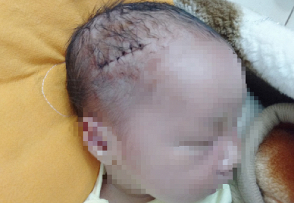 Đời sống - Gia đình hoảng hốt khi đón bé trai sơ sinh từ phòng mổ với 6 mũi khâu trên đầu