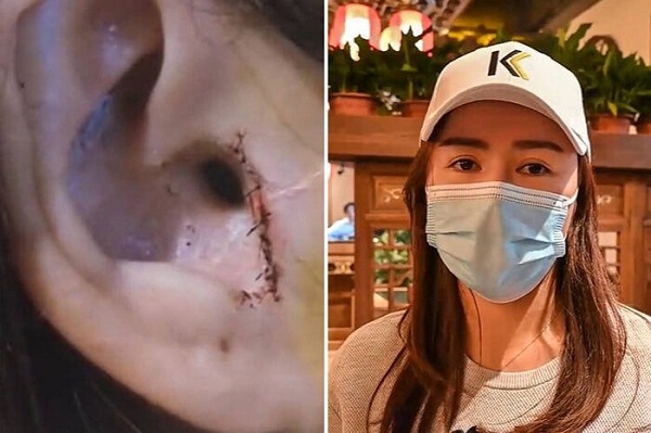 Cộng đồng mạng - Phẫu thuật nâng mũi, cô gái 'chết đứng' khi bác sĩ 'tiện tay' cắt luôn một phần da thịt
