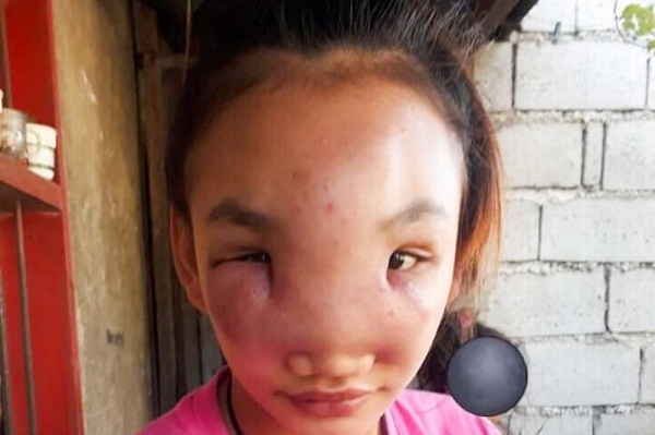 Đời sống - Thiếu nữ 17 tuổi nguy cơ bị mù sau khi nặn mụn trên mũi (Hình 2).