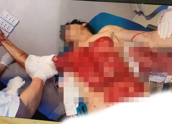 Tin tức - Tai nạn kinh hoàng: Nạn nhân bị lột toàn bộ da trước ngực vì cuốn vào máy bóc gỗ