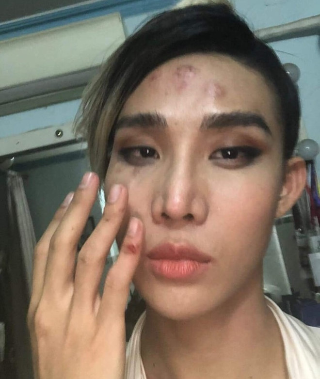 Tin trong nước - Người mẫu The Face tố bị tài xế Go-Viet hành hung, gây thương tích