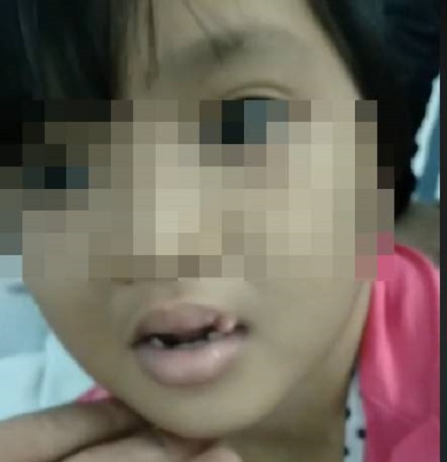 Tin trong nước - Những vết sẹo ám ảnh của bé gái 6 tuổi nghi bị 'chồng hờ' của mẹ đánh đập dã man, gí tàn thuốc vào người (Hình 2).