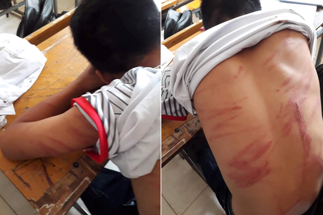Tin trong nước - Bé trai bị bố đánh đến nhập viện: 'Em không dám la hét, chỉ ôm tay vào mặt lăn dưới nền đất'