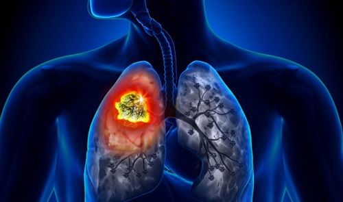 Tin tức - Bệnh ung thư phổi nguy hiểm như thế nào?