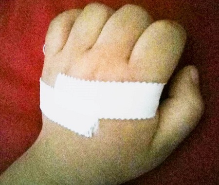 Tin tức - Bé gái gần 3 tuổi mắc bệnh ngón tay lò xo
