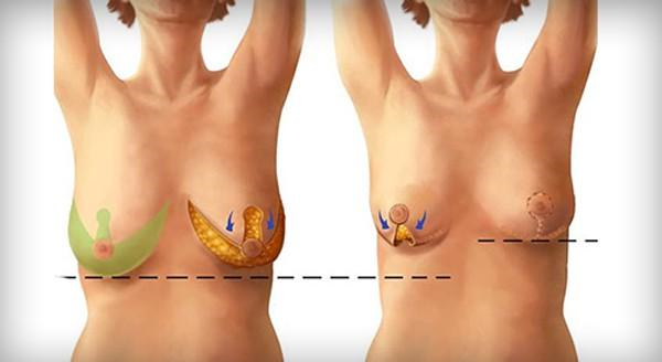 Quy trình phẫu thuật treo ngực sa trễ an toàn nhất hiện nay