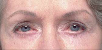 Y tế - Cách phục hồi cắt mí mắt bị trợn