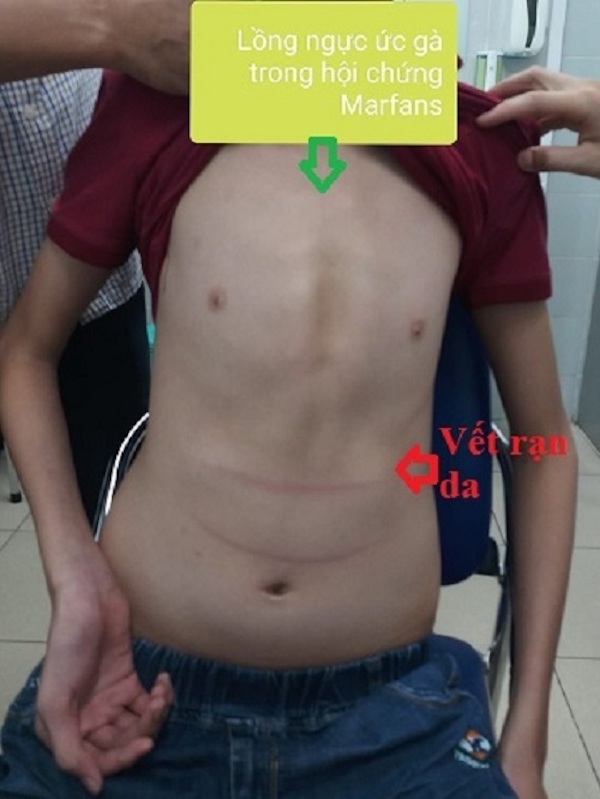 Y tế - Bé trai 11 tuổi ở Hà Nội cao 1m80 vì căn bệnh hiếm, cha mẹ cần lưu ý con khi thấy lớn bất thường