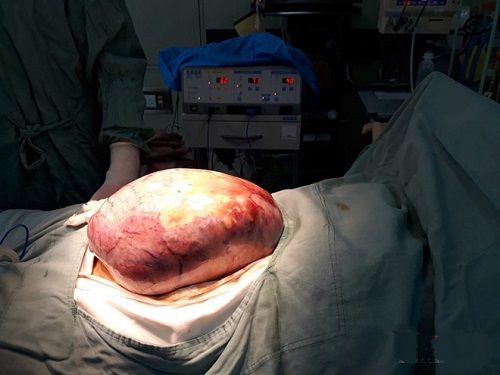BV TƯ Huế: Bóc tách thành công khối u buồng trứng khổng lồ nặng hơn 5kg - Ảnh 1