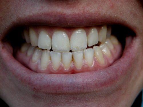 9 thói quen đang phá hỏng răng của bạn mỗi ngày - Ảnh 4