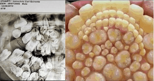 Ca bệnh kì lạ: Thiếu niên có tới 232 chiếc răng mọc thừa  - Ảnh 1