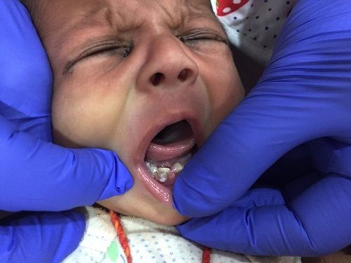 Em bé sinh ra đã có 7 chiếc răng  - Ảnh 1