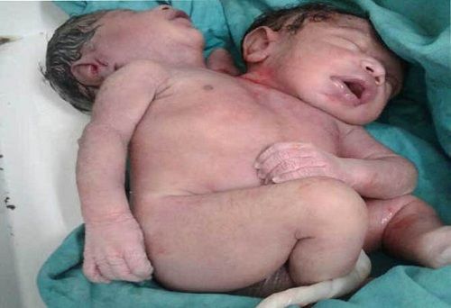 Em bé sinh ra có 2 đầu 3 cánh tay chỉ sống được vài giờ tại Ấn Độ - Ảnh 2