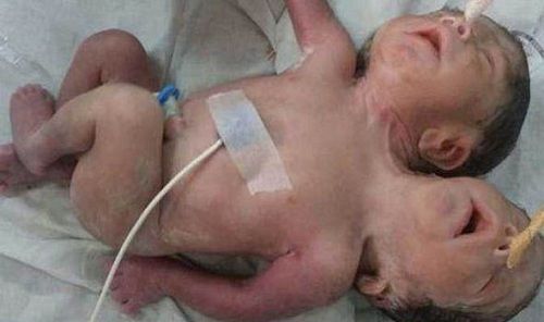 Em bé sinh ra có 2 đầu 3 cánh tay chỉ sống được vài giờ tại Ấn Độ - Ảnh 1