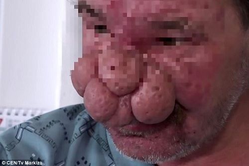 Người đàn ông có chiếc mũi 'khổng lồ' được phẫu thuật thành công - Ảnh 1
