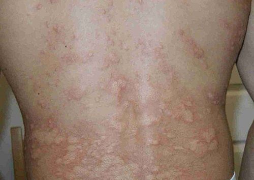 Nhận biết các bệnh về da vào mùa đông thường gặp - Ảnh 1