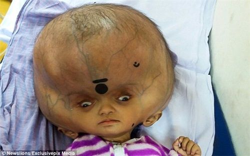 Mắc bệnh lạ, em bé có đầu to bất thường như "người ngoài hành tinh"  - Ảnh 1